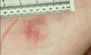 Ulcer